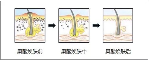 果酸的功效与作用