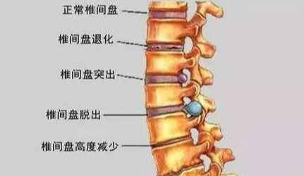 白醋能治腰椎间盘突出吗？