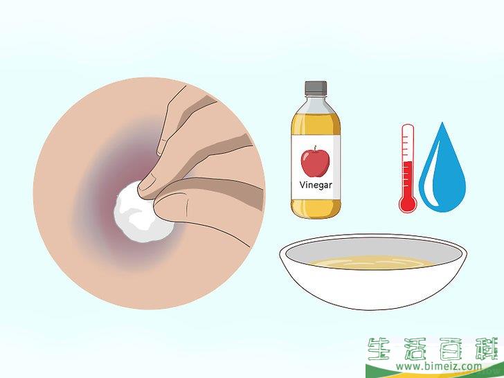 怎么快速消除淤青