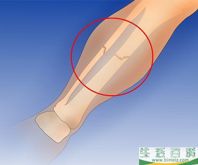 怎么预防外胫夹