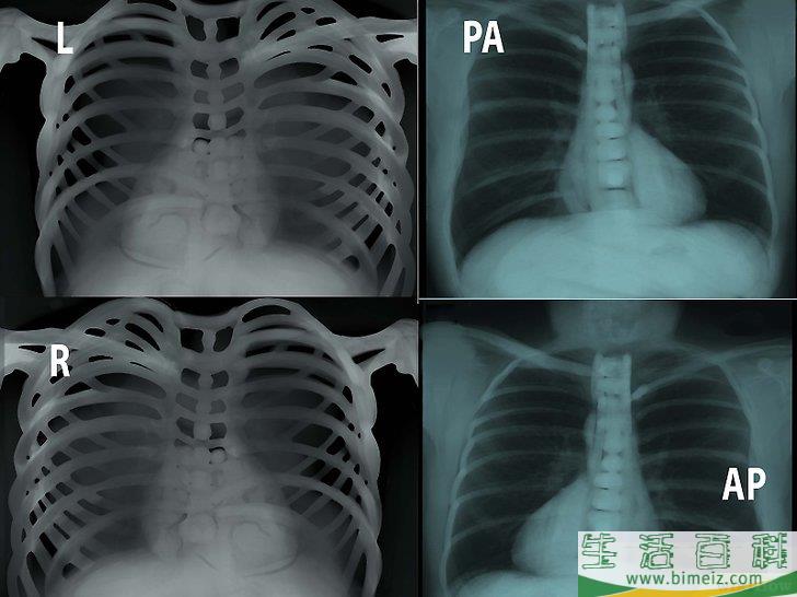 怎么看胸部平片