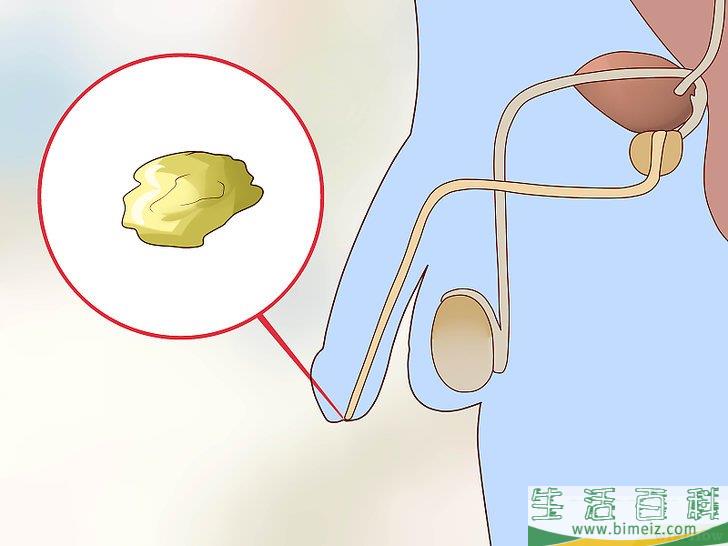 怎么检查阴茎是否有性病感染迹象