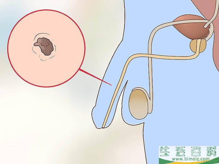 怎么检查阴茎是否有性病感染迹象